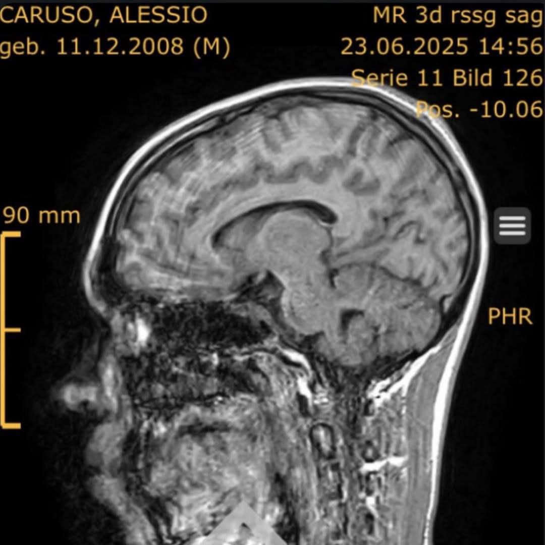 MRT-Scan von Alessios Kopf